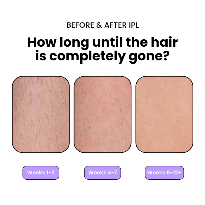 Flair Pro 2.0 IPL Hair Remover
